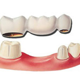 Izrada mostova i krunica