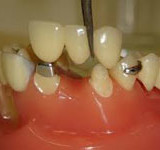 Livena nadogradnja zuba